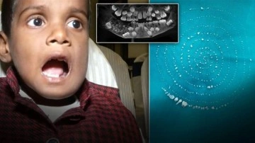 Çocuktan Çıkan Yüzlerce Minyatür Diş Şaşkınlık Yarattı